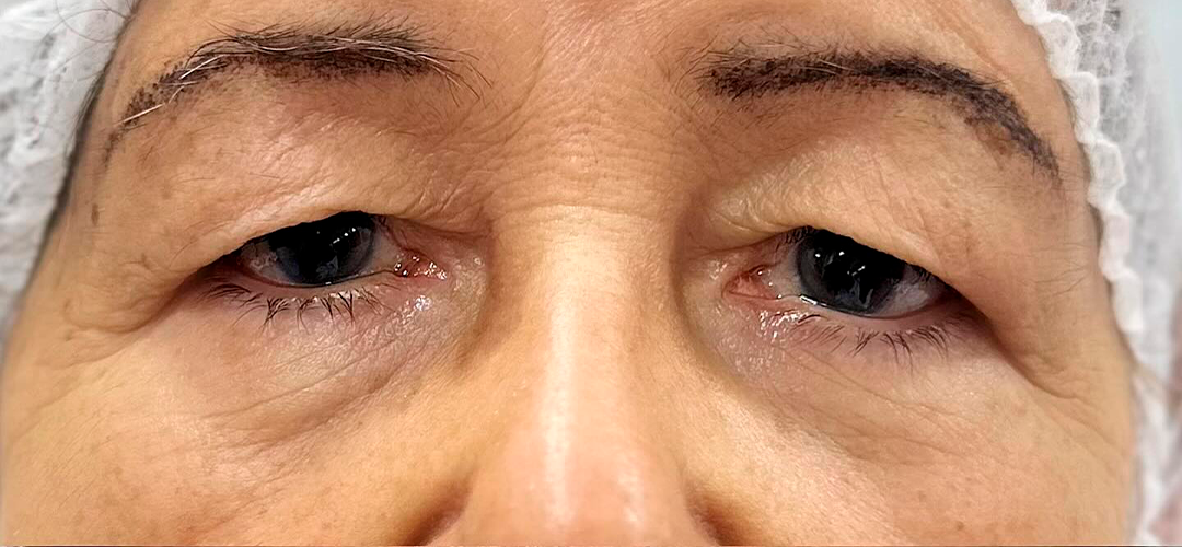 Antes do procedimento