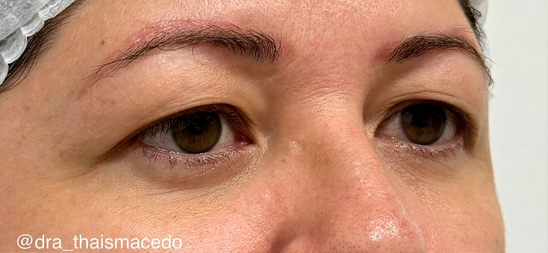 Antes do procedimento