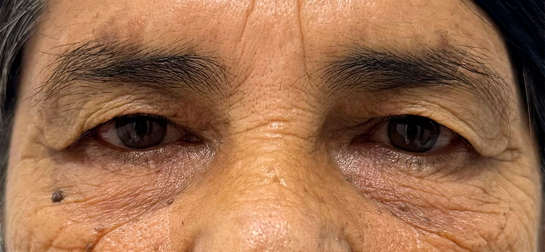 Antes do procedimento