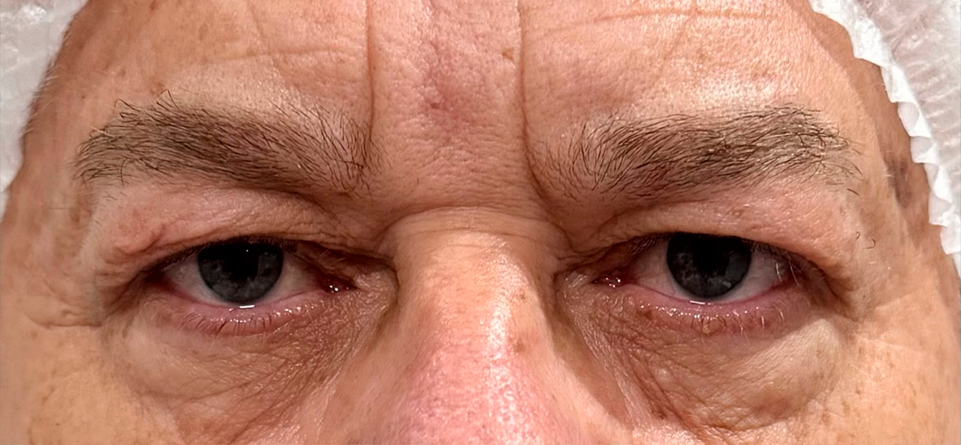 Antes do procedimento