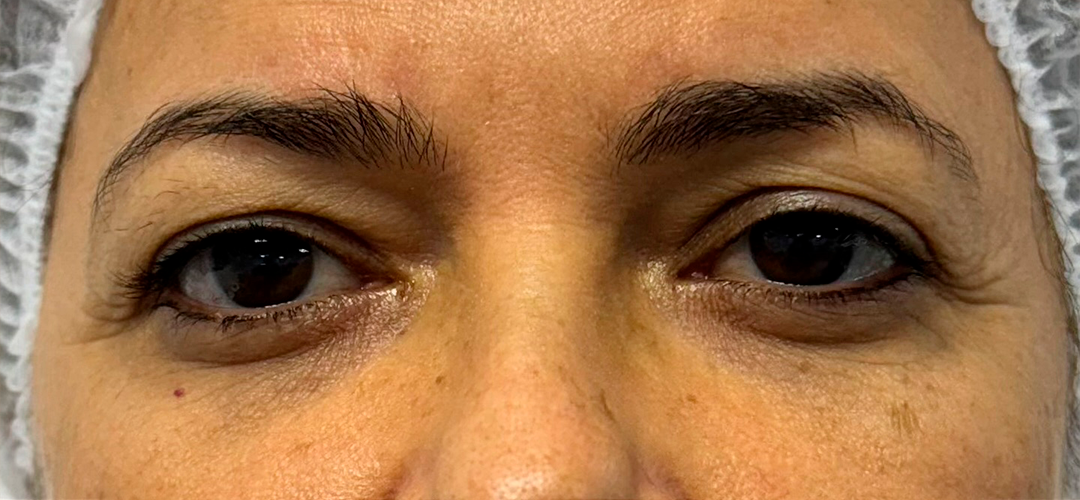 Antes do procedimento