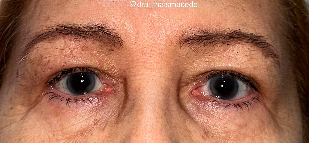 Depois do procedimento