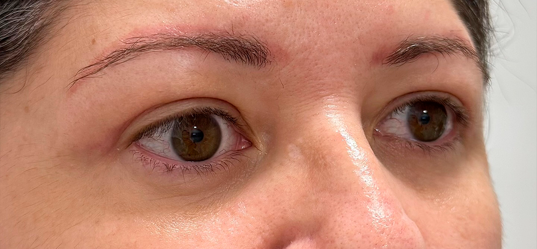 Depois do procedimento