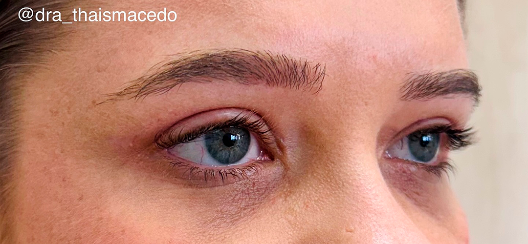 Depois do procedimento