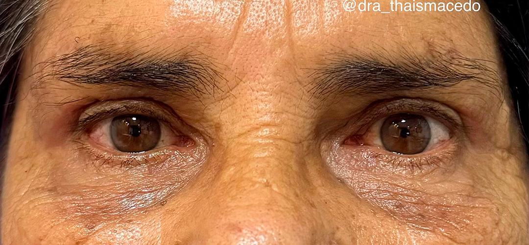 Depois do procedimento