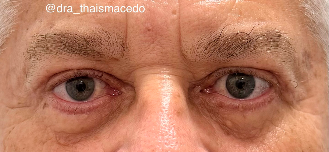 Depois do procedimento