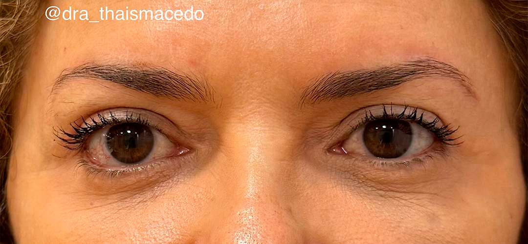 Depois do procedimento