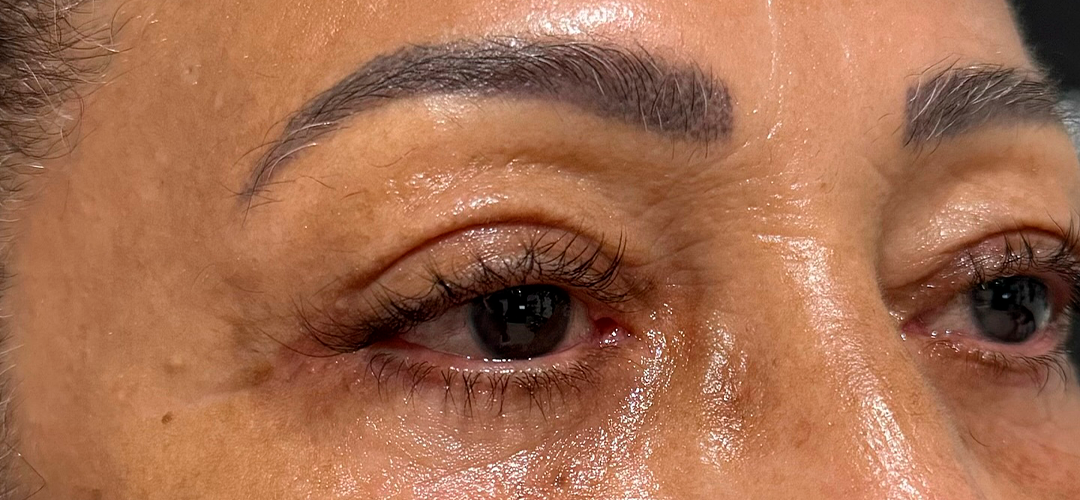 Depois do procedimento